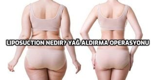 Liposuction Nedir? Yağ Aldırma Ameliyatı